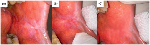 Figure 12. Patient suffering oral erythoplakia: (A) before treatment, (B) after 3 weeks and (C) after 6 weeks (treated with CurSLN-gel).