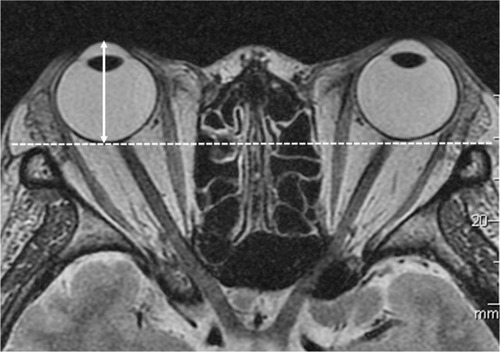 Figure 1 Exophthalmos measurement.