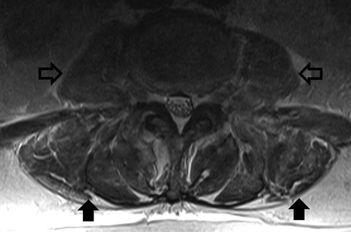 Figure 1. MRI of patient’s lumbar spine. T2 image with solid arrows showing edema of paraspinal muscles. Outlined arrows indicated psoas muscles, which are non-edematous