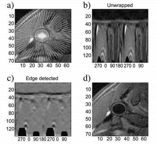 Figure 2. Results of the edge‐detection analysis showing a) reference lines for carotid vessel wall profile, b) “unwrapped” image data, c) results of gradient‐detection for inner (black) and outer (white) wall boundaries, and d) visual display of segmentation result (black lines).