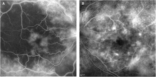 FIGURE 2  Fluorescein angiography of the right (A) and left (B) eyes during the late frames, demonstrating choroidal hypoperfusion and a petaloid pattern of leakage consistent with macular edema in the right eye and diffuse late leakage in the left eye.