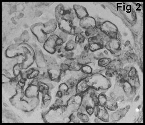 Figure 2 vWF staining in the glomerular subendothelium.