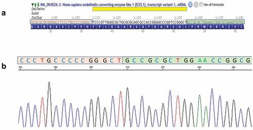 Figure 4. Graphical illustration of the variant c.110_155del p.(phe37cysfs *151) in ECEL1. (a) the genomic region of the 46 bp deletion (yellow) in Exon 2 showing the upstream (orange) and downstream (green) flanking sequences—from alamut visual (interactive bio software, SOPHIATM) (b) Electropherograms demonstrating homozygous mutated allele (Proband) showing the fused upstream (orange) and downstream (green) sequences.