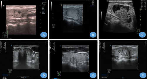 Figure 1 Typical features of different-sized benign and malignant thyroid nodules (A) benign thyroid nodule ≤10 mm (B) benign thyroid nodule 10–20 mm (C) benign thyroid nodule ≥20 mm (D) malignant thyroid nodule ≤10 mm (E) malignant thyroid nodule 10–20 mm (F) malignant thyroid nodule ≥20 mm.