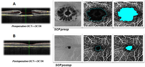 Figure 1. Preoperative (А) and postoperative (B) OCT + OCTA of SCP in а patient with FTMH. The structural OCT shows full thickness macular hole, and OCT-A images of SCP demonstrate enlargement of the FAZ area before surgery (А). The structural OCT shows the closure of macular hole after the surgery, and OCT-A images of SCP demonstrate reduction in the size of the FAZ area (B). Note: OCT: optical coherence tomography; OCTA: optical coherence tomography angiography; FTMH: full thickness macular hole; SCP: superficial capillary plexus; FAZ: foveal avascular zone.