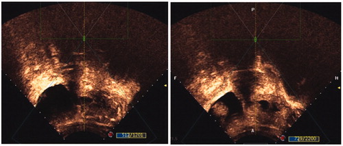 Figure 1. The blood flow of pregnancy tissue examined by transabdominal color Doppler scanning contrast medium before (left) and after (right) high-intensity focused ultrasound ablation.