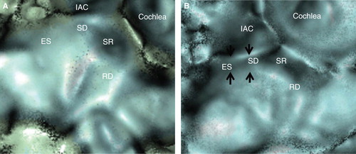 Figure 4. Representative views of the right ear of a patient with Meniere's disease (MD) (A) and a volunteer's healthy ear (B). (A) Both the bony grooves of the reuniting duct (RD) and the endolymphatic sinus (ES) are fully occupied by a dense, bony substance and it is hard to trace their luminal spaces, but that of the saccular duct (SD) is not fully occupied in the MD patient. (B) The bony grooves of the RD, SD and ES of the volunteer's healthy ear are not occupied and maintain their luminal spaces. The bony grooves of the SD and ES show continuous images (arrows). IAC, internal auditory canal; SR saccular recess.