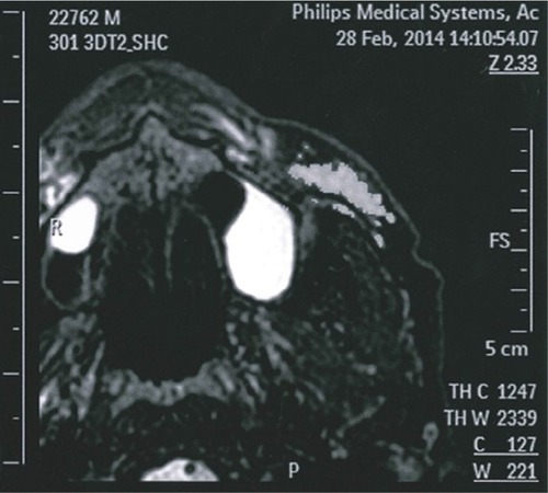 Figure 6 Axial T2 image of Subject 5 showing diffusion of HA gel into the deep fat compartment and along the vessels, most notably on the left side.