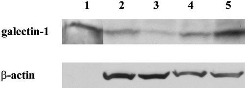 Figure 5. Placental galectin-1 is increased in severe PE. Fifteen ng of recombinant human galectin-1 and 30 μg of villous tissue lysates were electrophoresed on 15% (w/v) SDS-polyacrylamide gel. Proteins were electroblotted and probed with anti-human galectin-1 IgG. All samples used for the representative image were taken from placentas delivered at 39 weeks of gestation. Lane 1: recombinant galectin-1; lane 2: control; lane 3: SGA; lane 4: severe PE; lane 5: severe PE complicated with SGA. Galectin-1 migrated as a single 15-kDa band in all lanes. Galectin-1 immunopositive signal was the strongest in severe PE complicated with SGA.