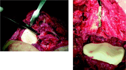 Figure 1. Modeling of the tibial component. Note the grooves on the tibial side and the line marked over the femur to help in proper rotation of the component. A curved Hohmann retractor and also finger pressure can be used to create two smooth grooves on the tibial component.