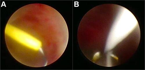 Figure 4 (A) Guide-wire insertion from the nephrostomy tube into the collecting system; (B) guide-wire was taken out with forceps for safety reasons.