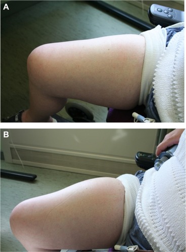 Figure 3 Skin pre- (A) and post- (B) hyaluronidase-facilitated subcutaneous immunoglobulin infusion (fSCIg) after 3 1/2 years of fortnightly infusions. Images of the thigh taken before and after the infusion of 130 mL of 16% Subcuvia (Baxter, Deerfield, IL, USA) at 100 mL/hour.Citation36 These show a diffuse swelling over a larger area than conventional SCIg with an absence of blanching and erythema, as the fluid is more widely distributed in the SC space. The initial SC injection of ovine hyaluronidase at a dose of 50 U/g of IgG was immediately followed by the Ig infusion. Reproduced from Journal of Clinical Pathology, Knight E, Carne E, Novak B, et al., 63(9), 846-847, 2010 with permission from BMJ Publishing Group Ltd.