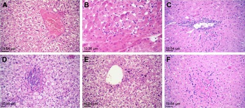 Figure 2 Liver and kidneys of hamsters of the injected group.Notes: (A) Liver of a hamster of the injected group showing marked vacuolar degeneration of hepatocytes and congestion of hepatic blood vessels (hematoxylin and eosin stain [H&E], magnification, ×20). (B) Liver of a hamster of the injected group showing perivascular mononuclear cell infiltration (H&E, ×20). (C) Liver of a hamster of the injected group showing sporadic foci of hepatic necrosis scattered throughout the hepatic parenchyma along with replacement of the necrotic tissue with mononuclear cells (H&E, ×20). (D) Liver of a hamster of the injected group showing paracentral area of coagulative necrosis of hepatocytes with mononuclear cell infiltration (H&E, ×20). (E) Liver of a hamster of the injected group showing focal areas of hepatic necrosis and sinusoidal leukocytosis (H&E, ×20). (F) Kidney of a hamster of the injected group showing marked vacuolar degeneration and necrosis of tubular epithelium associated with thickening of the tubular and glomerular basement membranes, swelling of glomerular tuft, congestion of intertubular blood vessels, and intertubular hemorrhage (H&E, ×40).