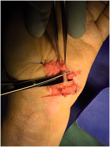 Figure 2. Appearance of the foreign body inside the ulnar nerve above the dissecting scissors in the Guyon’s canal.
