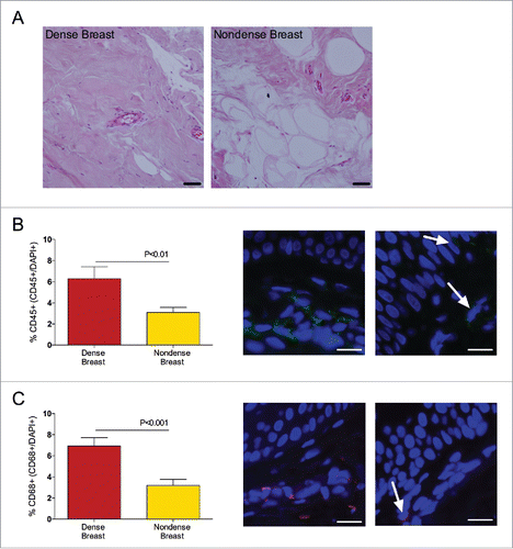 Figure 3. Dense breast tissue contains increased levels of inflammatory cells in 39 postmenopausal women, attending the regular mammography-screening program who underwent biopsies for research purposes. On their regular screening mammograms, the breast were categorized as either dense or nondense and thereafter the women were invited to participate in the study as described in the materials and methods section. Breast biopsies were obtained in the upper lateral quadrant of the left breast. Tissue sections were stained and quantified as described in Materials and Methods. Graphed data are presented as mean ± SEM. (A) Representative H&E-stained tissue sections from dense and nondense breast tissue, respectively. Scale bars = 50 μm. (B) Sections were stained with CD45 (green). Significantly increased levels of leucocytes were detected in dense breast tissue. Representative tissue sections from each group are shown. Arrows indicate CD45+ cells. Scale bars =100 μm. (C) Sections were stained with CD68 (red). Significantly increased levels of leucocytes were detected in dense breast tissue. Representative tissue sections from each group are shown. Arrows indicate CD68+ cells. Scale bars =100 μm