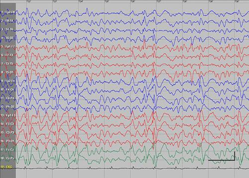 Figure S2 Absence status epilepticus in patient 3. Vertical bar - 100uV, horizontal bar - 1 sec.