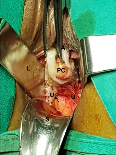 Figure 1 Anteriorly forward traction of the posterior lip of cervix (PC) by Alli’s forceps (A), and backward stretch of posterior vaginal incision by Sim’s speculum (S), defines the uterosacral ligaments pillars (U) indicated by arrow, lateral vaginal wall retractor (L).