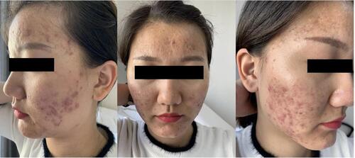 Figure 3 A female patient aged 20 of the observed group. Frontal and bilateral clinical photos of the face before treatment.