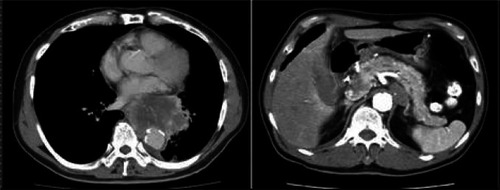 Figure 3 Tumors in the left lower lobe of the lung (left) and in the parapancreatic head (right)