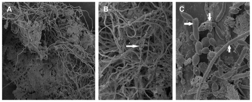 Figure 4 SEM of a mixture of morphological forms of Candida albicans biofilm developed on the inner surface of the CVC. Magnification: (A) ×450; (B) ×1100; (C) ×4500.