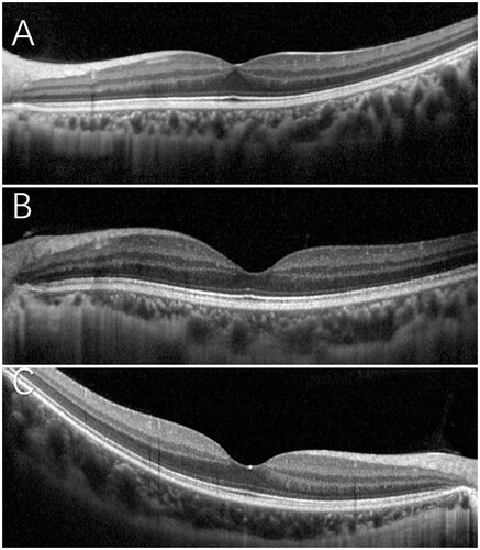 Figure 2. OCT images of IRL group (A), non-IRL group (B), and control group (C).