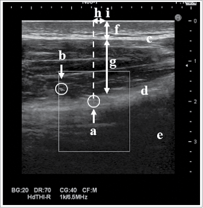 Figure 2. Ultrasound image at 2/3 bb’. a: The posterior circumflex humeral artery (PCHA) (main trunk), b: PCHA (branch), c: superficial fascia, d: deep fascia, e: humerus, f: subcutaneous tissue, g: deltoid muscle, h: distance from the PCHA to 2/3 bb’, i: the site of 2/3 bb’.