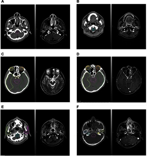 Figure 1 Organs at risk (OARs) contoured on planning computed tomography (CT) with magnetic resonance imaging (MRI) fusion. (A) Brain stem contoured on CT with MRI image fusion; (B) spinal cord contoured on CT with MRI image fusion; (C) eyeball, optic chiasm and temporal lobe contoured on CT with MRI image fusion; (D) lens and optic never contoured on CT with MRI image fusion; (E) parotid gland contoured on CT with MRI image fusion; and (F) temporomandibular joint and inner ear contoured on CT with MRI image fusion.