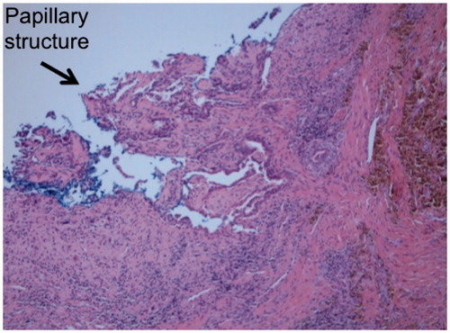 Figure 2. Histopathology demonstrating glandular structures with a focal papillary pattern.