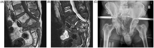 Figure 1. T1 (A) and T2 (B) MRI axial sections showing sacral fracture. (C) Radiography showing external fixation for bilateral ilio–ischio–pubic fractures and coiling of both internal iliac arteries.