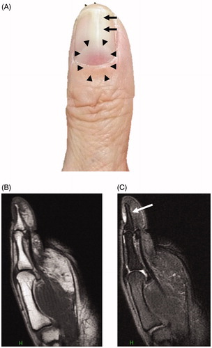 Figure 1. Clinical findings and MRI images. (A) A reddish mass of 4-mm diameter is seen under the nail plate (area surrounded by the triangle mark). Distal nail splitting is observed in the left thumb. (B) T1-weighed magnetic resonance image shows tumor with normal intensity. (C) T2-weighed magnetic resonance image shows high-intensity lesion. Flow void is indicated by an arrow. MRI: magnetic resonance imaging.