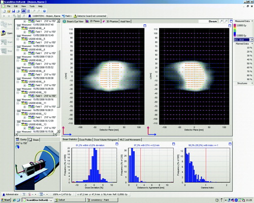 Figure 2.  A screenshot from the Delta4 software showing the result of delivery of a prostate case. In the upper panels are shown the absolute dose measurements in the two diode arrays with color coding denoting the dose. In the lower panel is shown three graphs; the left-most graph shows the dose deviations from the planned dose, the middle graph shows the distance to agreement from the planned dose, and the right-most graph shows the gamma index distribution.