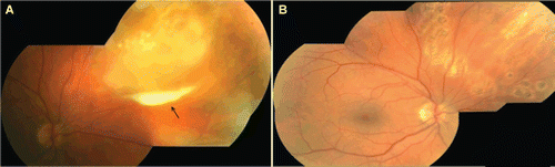FIGURE 1  (A) Mosaic color fundus photograph of the right eye, demonstrating focal and confluent areas of necrosis of the peripheral retina. Preretinal exudate, a “pseudohypopyon,” is also shown in addition to areas of retinal necrosis (arrow). (B) Mosaic color fundus photograph of the right eye after pars plana vitrectomy and laser retinopexy treatment, showing resolved retinal necrosis.