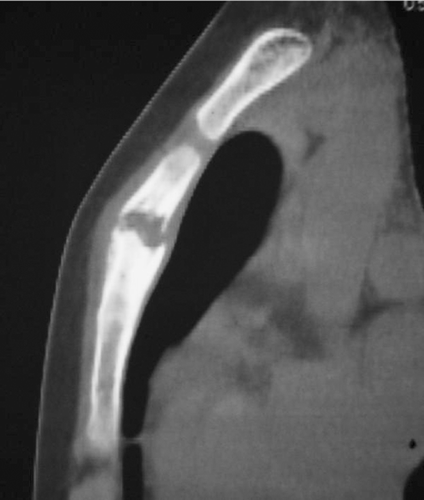 Figure 2.  Computed tomography (CT) showed an osteolytic lesion that dissolved both anterior and posterior cortex of the body of the sternum.