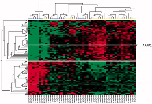 Figure 1. Hierarchical cluster analysis showing the 81 significantly altered genes (p<.01) with fold changes of ±1.2 in primary tumors of older HGSC patients (>70 years) with early (<6 months, 20 patients, blue) versus late disease progression (>12 months, 30 patients, yellow). Red: higher levels, green: lower levels in the early versus late disease progression group. Heatmaps were generated using the Qlucore Omics Explorer™ software. The ARAP1 gene selected for further analysis is marked in the heat map with thin white lines.