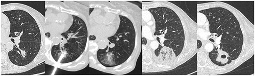 Figure 6. CT axial images. Evolution cavitation of a bronchial adenocarcinoma.