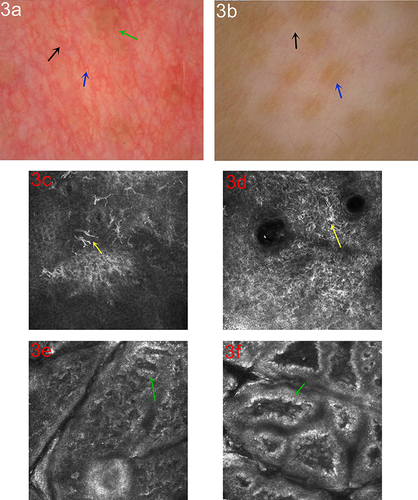 Figure 3 Dermoscopic and RCM changes in the process of treatment. (a) Dermoscopic observation showing increased pigment at the lesion (green arrow), white hair restoration (black arrow) and telangiectasia (blue arrow, polarized light ×50); (b) increased pigment around the hair follicle (blue arrow), white hair restoration (black arrow, polarized light ×20); (c) RCM observation of the repigmentation process showed dendritic melanocytes (yellow arrow); (d) starburst-like dendritic melanocytes (yellow arrow); (e) the pigment rings increased in the basal layer and were bent into a “mitochondrial crista-like” structure (green arrow); (f) Increase of pigment granules in the basal layer (green arrow).