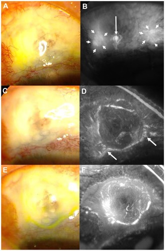 Figure 1 Anterior ocular segment from an 80-year-old man in the combination eye drop group photographed with a fundus camera after fluorescein staining. (A and B) Epithelial defects (arrowheads) and bleb leakage with a leak point (arrow) are visible in this monochrome photograph taken in fluorescein angiogram mode. (C and D) Four months after the start of treatment, the epithelial defects and leakage had resolved, and several microcysts were observed on the bleb wall (arrows). (E and F) By 40 months, the bleb had contracted slightly, and the number of microcysts had decreased.
