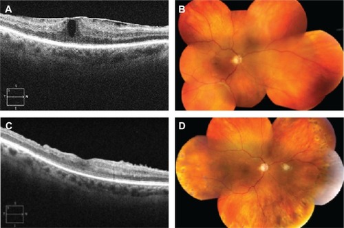 Figure 2 Choroidal effusion resolved and retinal detachment persisted at 2 months following ocriplasmin injection.