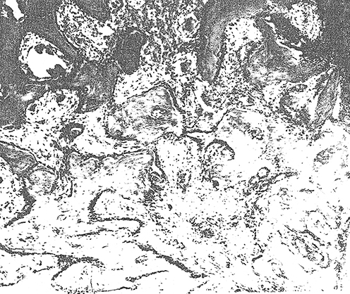 Figure 5 Microphotograph. An area of active osteoclastic resorption of compact bone. Haematoxylin and eosin staining. x120.