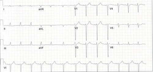 Figure 1 ECG (QRS 116 ms) at rest before CRT.