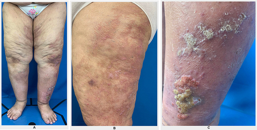 Figure 3 Clinical image of skin lesions 2 months after treatment. (A) Skin lesions on lower legs. (B) Erythematous plaques on left thigh. (C) Verrucous plaques on left lower leg.