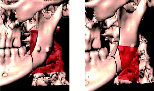 Figure 3. A planar cutting tool is used to graphically insert fractures in a surface model of the mandible. [Color version available online.]
