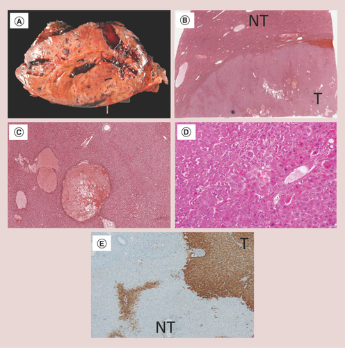 Figure 4. Surgical samples of sonic hedgehog hepatocellular adenoma and β-catenin exon-3-mutated hepatocellular adenoma.Sonic hedgehog hepatocellular adenoma: macroscopic view of a large liver nodule with hemorrhagic areas (A). Low magnification demonstrating a sharply limited hepatocellular nodule with hemorrhagic areas (B) and (C). β-catenin exon-3-mutated HCA with cellular atypia: microscopic examination shows a well-differentiated hepatocellular tumor with cellular atypia (large, hyperchromatic nuclei and bi-nucleated cells) (D). Glutamine synthase is strongly expressed in the tumor (E).HCA: Hepatocellular adenoma; NT: Nontumor; T: Tumor.