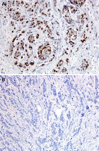 Figure 1 Immunostaining for TOP2A in preoperative breast cancer core biopsies.