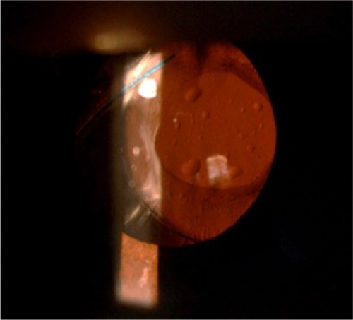 Figure 2 The largest silicone oil droplet was aspirated by 20-gauge vitrector and the residual smaller ones were swept peripherally by a 27-gauge bending tip cannula.