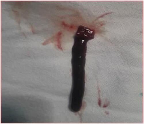 Figure 1 The leech removed from oropharynx of 10 months infant at Debre Tabor General Hospital, 2018.