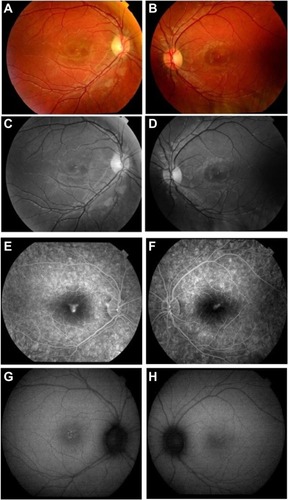 Figure 1 (A and B) Fundus photographs showing yellowish, oval-shaped drusenoid-like lesion with attenuation of the foveal reflex in both eyes. (C and D) Red-free fundus photographs showing heterogeneous foveal lesions. (E and F) Fluorescein angiogram showing early foveal hyperfluorescence with late ill-defined leakage in right eye and left eye, respectively. (G and H) Autofluorescence photos showed heterogeneous hyperfluorescence in the macula of both eyes.Note: A,C,E, and G are right eye; B,D,F, and H are left eye.