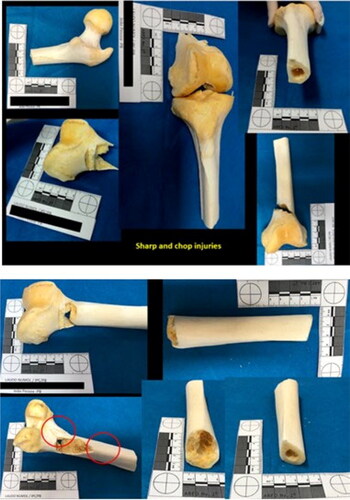 Figure 10. Blunt, sharp, and chop injuries at the distal epiphysis of the femurs and their diaphysis.