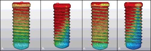 Figure 1. Von Mises values in cylindrical implants: vertical (a) and oblique (b) loading on D1 bone density; vertical (c) and oblique (d) loading on D4 bone density.