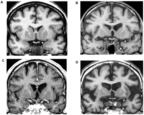 Figure 1 Mesiotemporal atrophy in the AD MR class of converters to dementia of the Alzheimer type. These oblique coronal reformatted T1-weighted images at the level of the anterior parahippocampal gyri are from a nonconverter (A) and three AD MR type converters (B, C and D), respectively 41 (B), 17 (C) and 11 (D) months before diagnosis of dementia. Compared with the nonconverter, these converters showed predominantly left mesial temporal atrophy and ventricular enlargement and marked atrophy of the AD type; there was a marked dilatation of the left rhinal sulcus (long arrows) and concave superior border of the anterior amygdala region (short arrows).